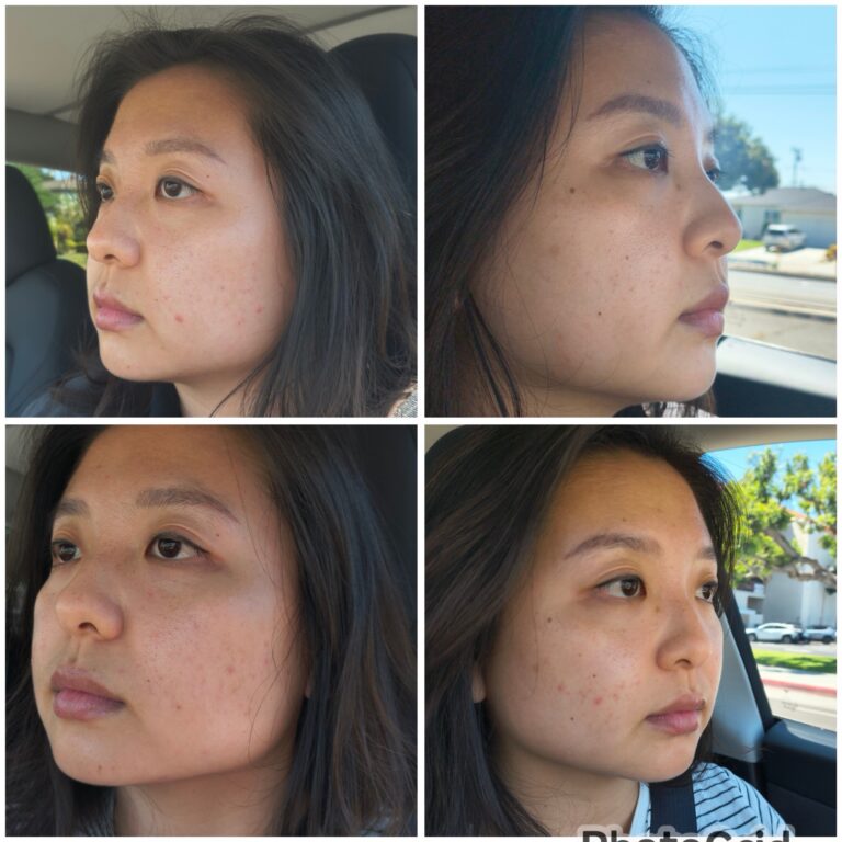 My First Experience with Microneedling + PRP (with aftercare and results)